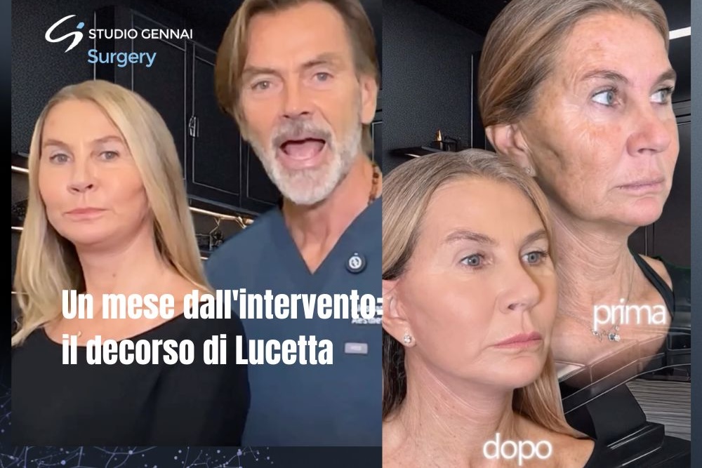 risultati chirurgia viso 1 mese