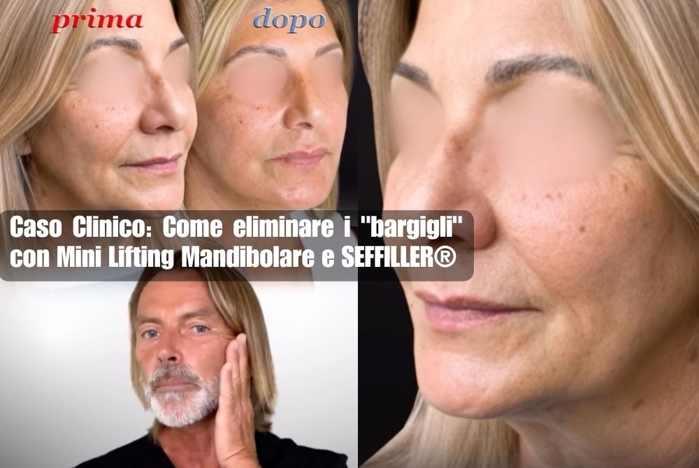 mini lifting mandibolare bargigli
