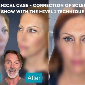 scleral show correction