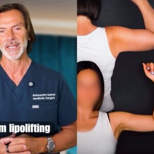 arm lipolifting after weight loss