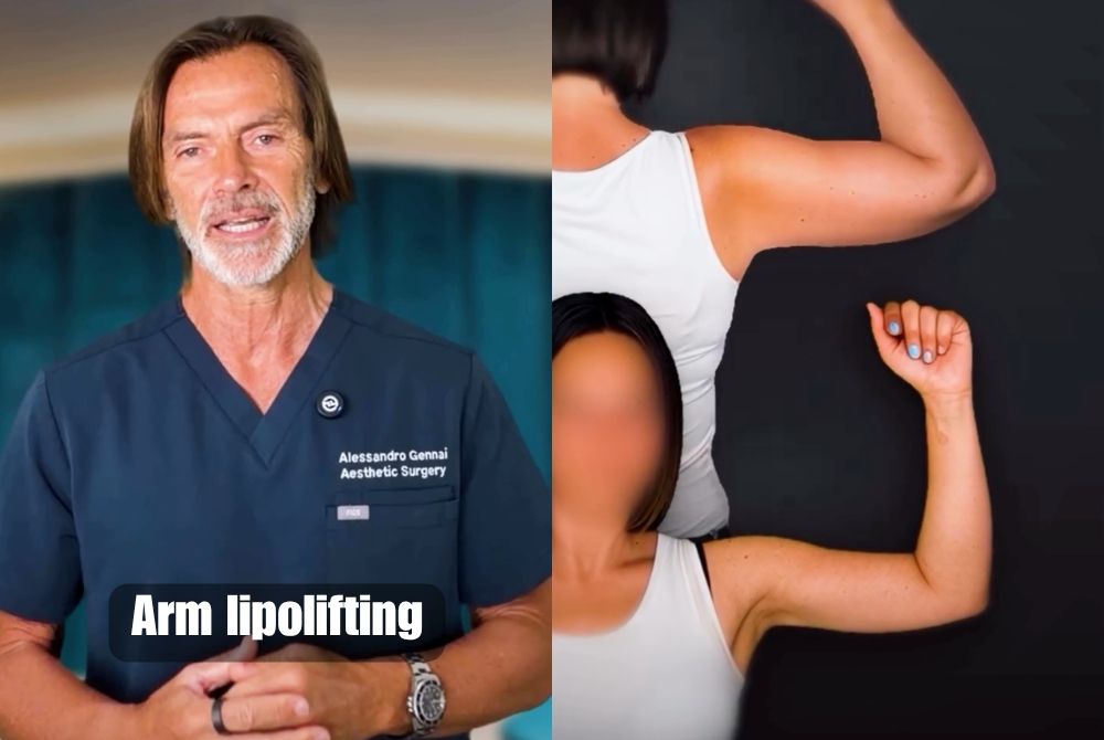 arm lipolifting after weight loss