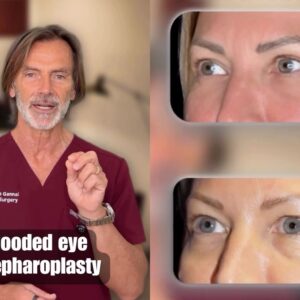 hooded eye blepharoplasty
