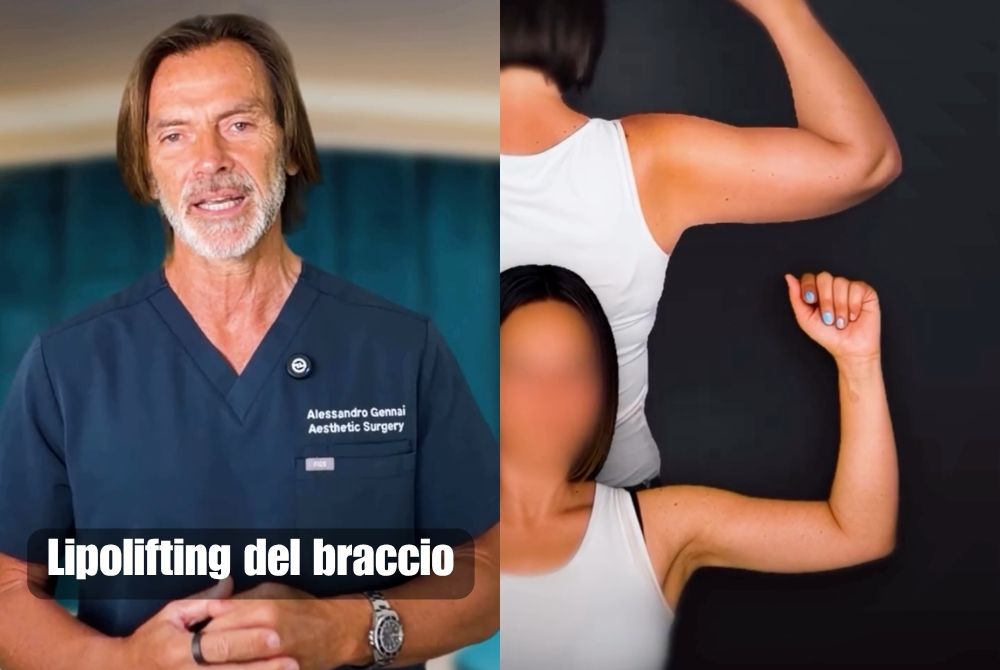 lipolifting braccia post dimagrimento