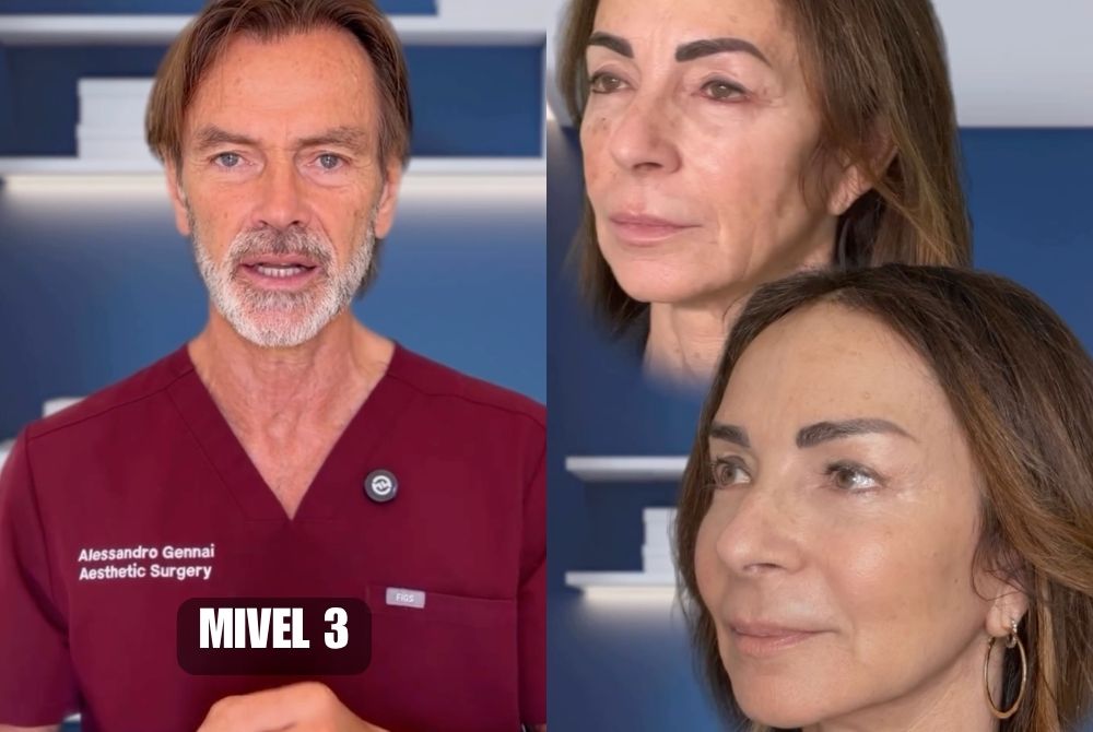 lifting endoscopico viso mivel